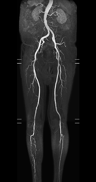 MRA run-off study with mDIXON