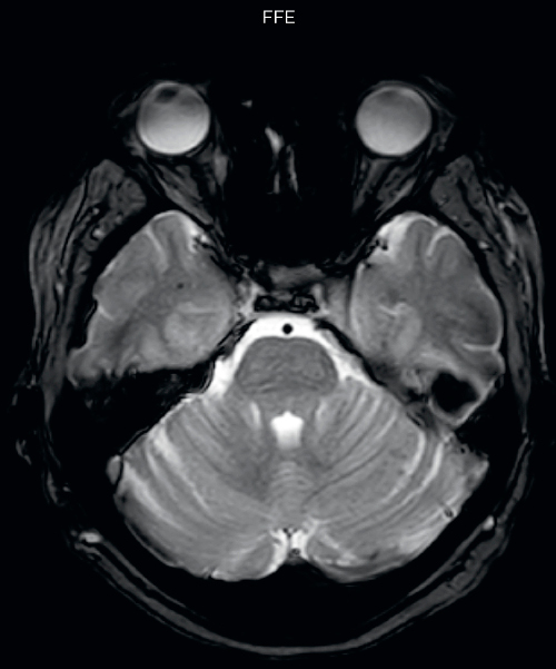 UVM case 1 FFE hemosiderin foci in brain1