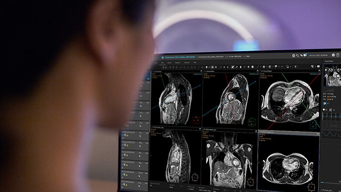 Philips advances Cardiac MR with a new suite of innovations powered by AI to expand patient access and improve diagnostic precision